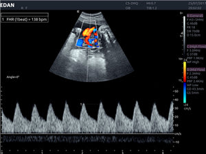 EDAN ACCLARIX LX8 - ULTRASONIDO DE CONSOLA DOPPLER COLOR - 3D/4D