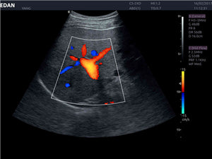 EDAN ACCLARIX LX8 - ULTRASONIDO DE CONSOLA DOPPLER COLOR - 3D/4D